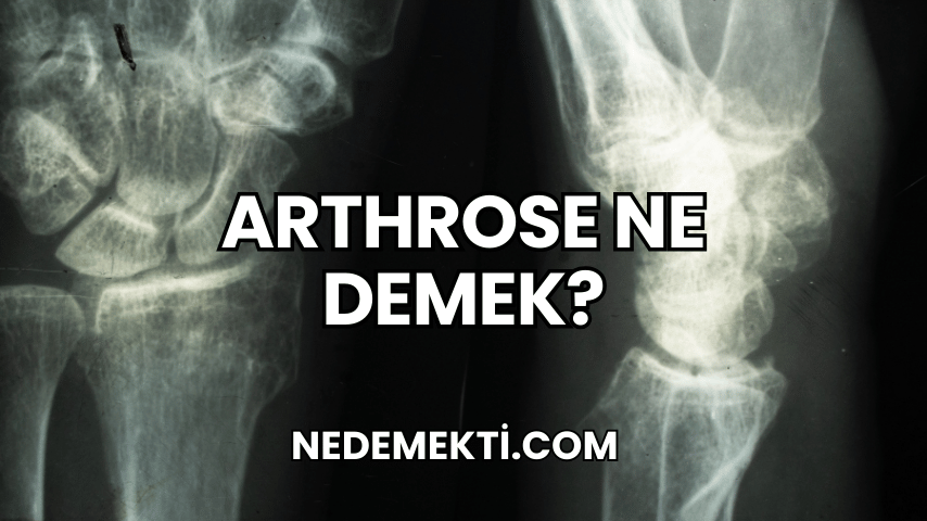 Arthrose Ne Demek?